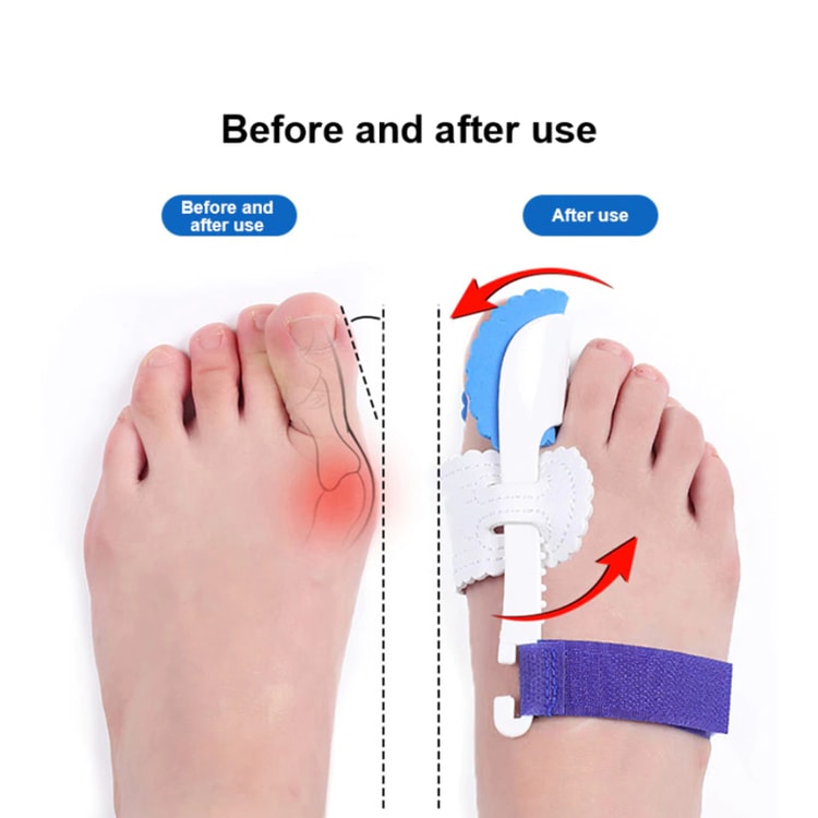 Adjustable Toe Alignment Support for Men &amp; Women